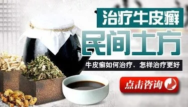 治疗银屑病的土方法有哪些